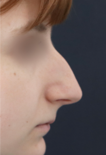 TJ Before Rhinoplasty