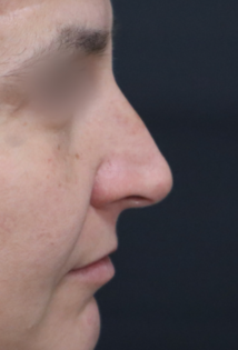 TJ Before Rhinoplasty