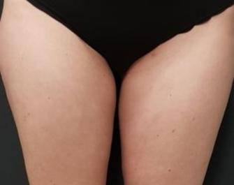 Thigh Liposuction After Image 1