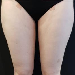 Thigh Liposuction After Image 4