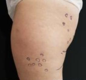 Thigh Liposuction Before Image 3