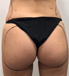 Liposuction Before 2