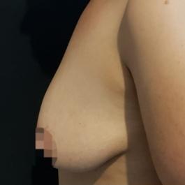 Breast Augmentation Before Image 14