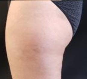 Thigh Liposuction After Image 3