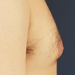 Nipple Reduction Before Image 1