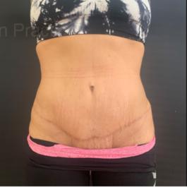 Tummy Tuck After Image 15