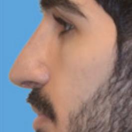Male Rhinoplasty After Image 6