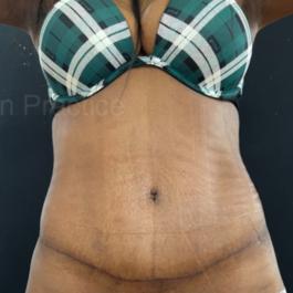 Tummy Tuck After Image 14