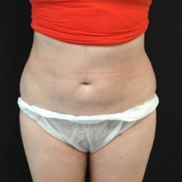 Stomach Liposuction After Image 3