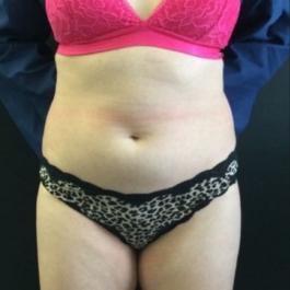 Stomach Liposuction Before Image 3