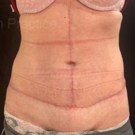 Tummy Tuck After Image 13