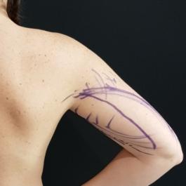 Arm Liposuction Before Image 2
