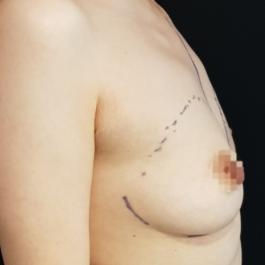 Breast Augmentation Before Image 13