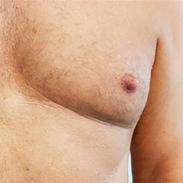Nipple Reduction Before Image 6