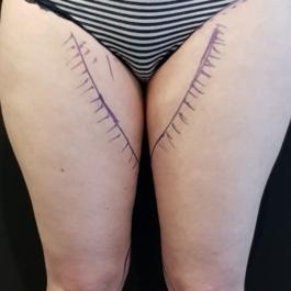 Thigh Liposuction Before Image 4
