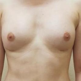 Fat Transfer Breast After Image 1