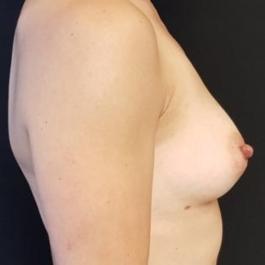 Fat Transfer Breast After Image 3