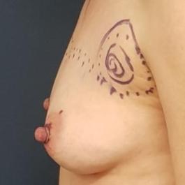 Fat Transfer Breast Before Image 4