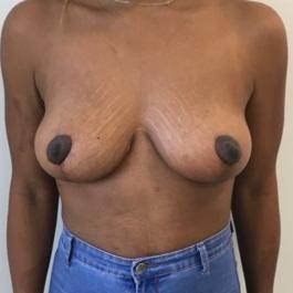 Mastopexy After Image 6