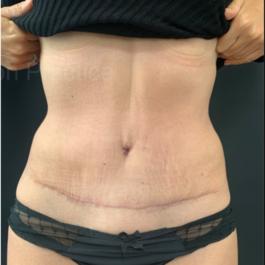 Tummy Tuck After Image 16