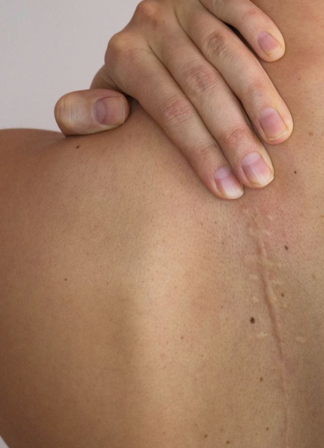 Hard Lumps After Sex Pregnant - Mole Removal Scars: Will mole removal leave a scar?